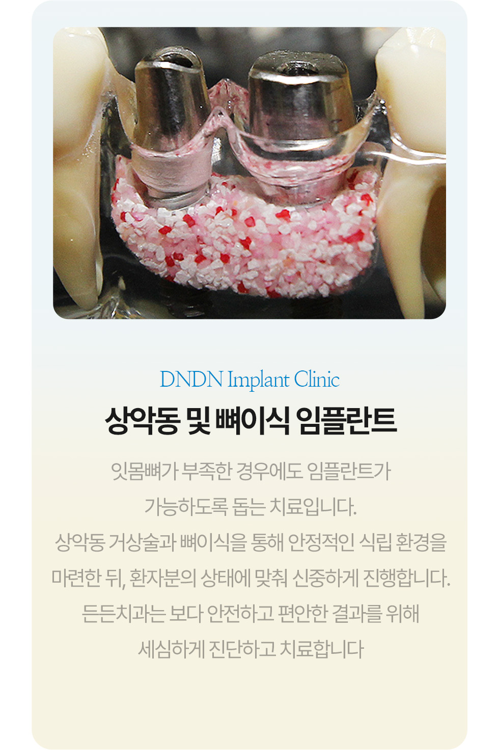 전악 임플란트