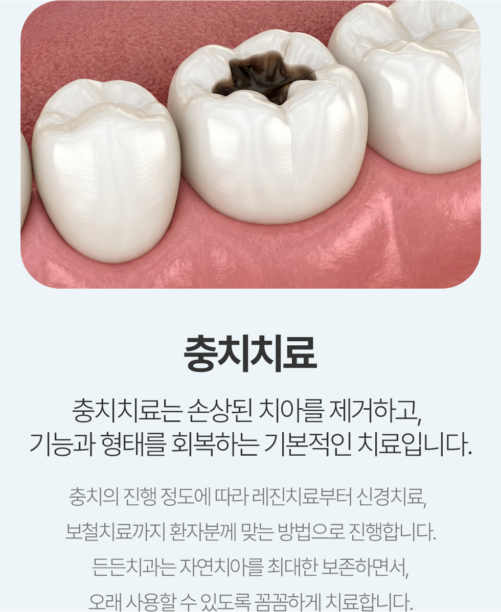 충치치료